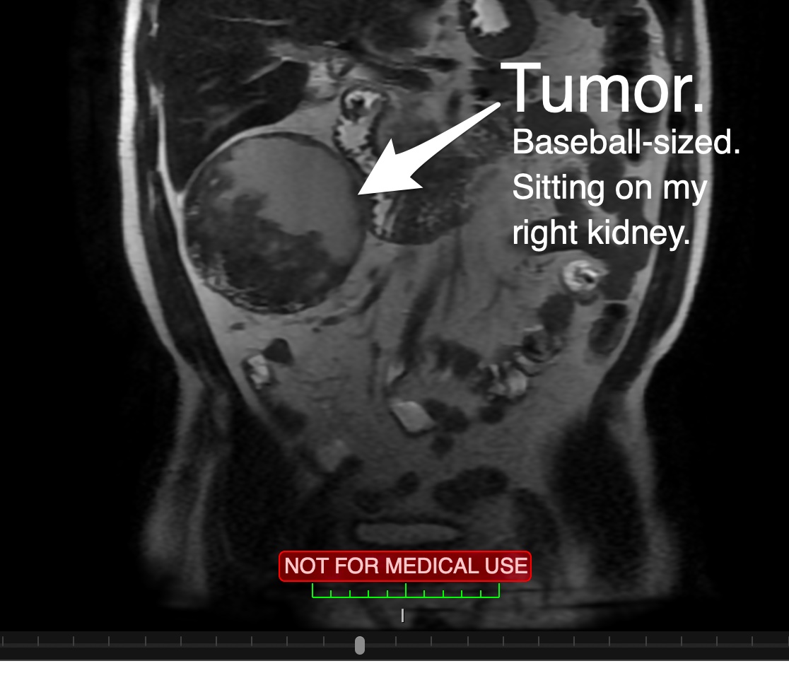 MRI Tumor - RayHightower.com